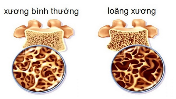 Hậu quả của loãng xương sẽ gây gãy xương.